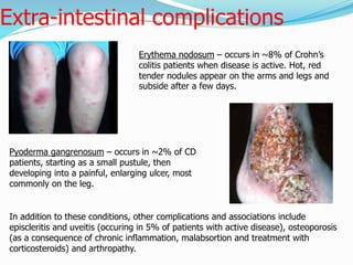 Morbus crohn dhe koliti ulceroz,, | PPTX