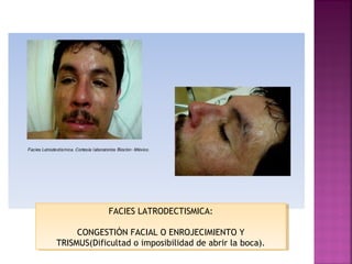 FACIES LATRODECTISMICA:
CONGESTIÓN FACIAL O ENROJECIMIENTO Y
TRISMUS(Dificultad o imposibilidad de abrir la boca).
FACIES LATRODECTISMICA:
CONGESTIÓN FACIAL O ENROJECIMIENTO Y
TRISMUS(Dificultad o imposibilidad de abrir la boca).
 