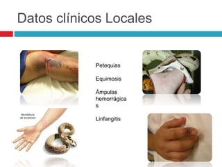 Datos clínicos Locales
Petequias
Equimosis
Ámpulas
hemorrágica
s
Linfangitis
 