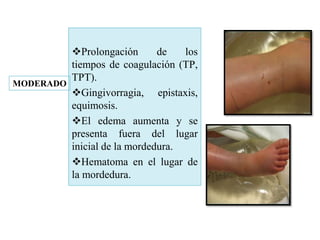 Prolongación de los
tiempos de coagulación (TP,
TPT).
Gingivorragia, epistaxis,
equimosis.
El edema aumenta y se
presenta fuera del lugar
inicial de la mordedura.
Hematoma en el lugar de
la mordedura.
MODERADO
 