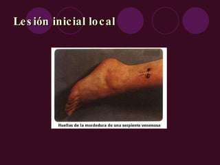 Lesión inicial local 