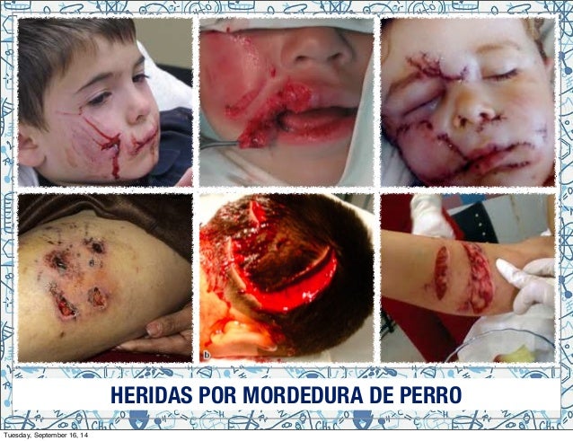 Heridas por Mordeduras