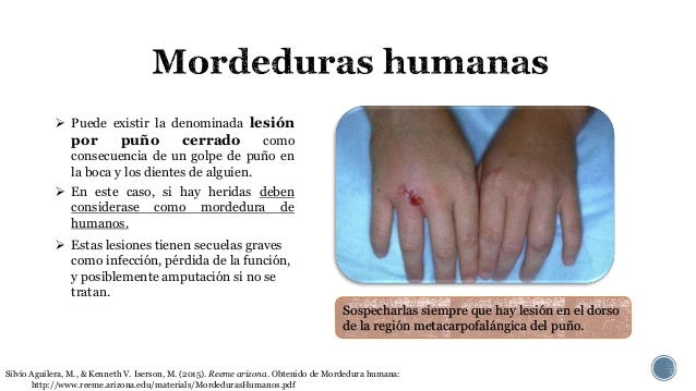 Mordeduras humanas