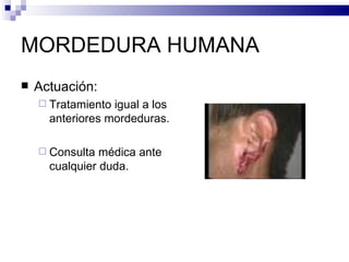 MORDEDURA HUMANA Actuación: Tratamiento igual a los anteriores mordeduras. Consulta médica ante cualquier duda. 