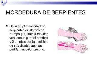 MORDEDURA DE SERPIENTES De la amplia variedad de serpientes existentes en Europa (14) sólo 5 resultan venenosas para el hombre y 2 de ellas por la posición de sus dientes apenas podrían inocular veneno. 