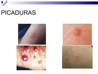 PICADURAS 