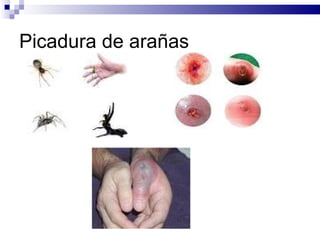 Picadura de arañas 