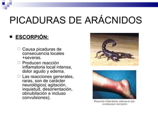 PICADURAS DE ARÁCNIDOS ESCORPIÓN: Causa picaduras de consecuencia locales +severas. Producen reacción inflamatoria local intensa, dolor agudo y edema. Las reacciones generales, raras, son de carácter neurológico( agitación, inquietud, desorientación, obnubilación e incluso convulsiones). 