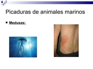 Picaduras de animales marinos Medusas:   