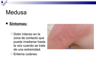 Medusa Síntomas: Dolor intenso en la zona de contacto que puede irradiarse hasta la raíz cuando se trata de una extremidad. Eritema cutáneo. 