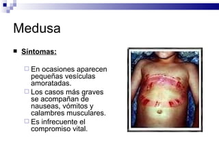 Medusa Síntomas: En ocasiones aparecen pequeñas vesículas amoratadas. Los casos más graves se acompañan de nauseas, vómitos y calambres musculares. Es infrecuente el compromiso vital. 
