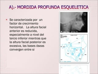 Se caracterizada por  un factor de crecimiento horizontal.  La altura facial anterior es reducida, especialmente a nivel del tercio inferior mientras que la altura facial posterior es excesiva, las bases óseas convergen entre si 