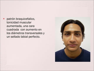 patrón braquicefalico, tonicidad muscular aumentada, una cara cuadrada  con aumento en los diámetros transversales y un sellado labial perfecto. 