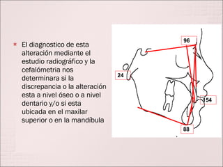 El diagnostico de esta alteración mediante el estudio radiográfico y la cefalómetria nos determinara si la discrepancia o la alteración esta a nivel óseo o a nivel dentario y/o si esta ubicada en el maxilar superior o en la mandíbula 96 154 88 24 