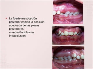 La fuerte masticación posterior impide la posición adecuada de las piezas posteriores manteniéndolas en infraoclusion 