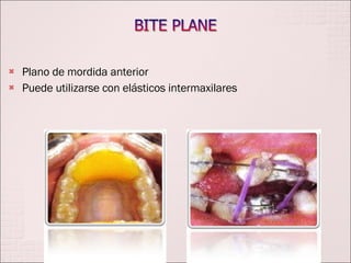 Plano de mordida anterior  Puede utilizarse con elásticos intermaxilares 