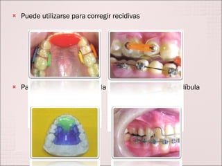 Puede utilizarse para corregir recidivas Para la extrusión pasiva y la auto rotación de la mandíbula  