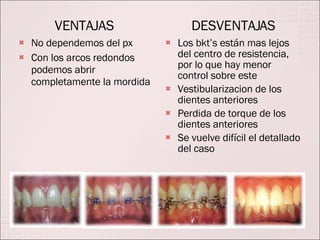 VENTAJAS No dependemos del px Con los arcos redondos podemos abrir completamente la mordida DESVENTAJAS Los bkt’s están mas lejos del centro de resistencia, por lo que hay menor control sobre este Vestibularizacion de los dientes anteriores Perdida de torque de los dientes anteriores Se vuelve difícil el detallado del caso 
