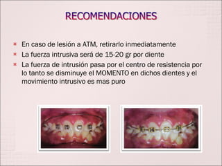 En caso de lesión a ATM, retirarlo inmediatamente La fuerza intrusiva será de 15-20 gr por diente La fuerza de intrusión pasa por el centro de resistencia por lo tanto se disminuye el MOMENTO en dichos dientes y el movimiento intrusivo es mas puro 