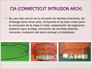 Su uso mas común es la intrusión de dientes anteriores, sin embargo tiene otros usos, incluyendo el tip back molar para la corrección de la clase II molar, preparación del segmento posterior para anclaje, corrección de mordida abiertas menores, nivelación del plano oclusal y el detallado. 
