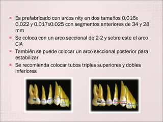 Es prefabricado con arcos nity en dos tamaños 0.016x 0.022 y 0.017x0.025 con segmentos anteriores de 34 y 28 mm Se coloca con un arco seccional de 2-2 y sobre este el arco CIA También se puede colocar un arco seccional posterior para estabilizar Se recomienda colocar tubos triples superiores y dobles inferiores 