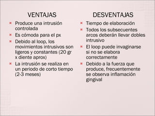 VENTAJAS Produce una intrusión controlada Es cómoda para el px Debido al loop, los movimientos intrusivos son ligeros y constantes (20 gr x diente aprox) La intrusión se realiza en un periodo de corto tiempo (2-3 meses) DESVENTAJAS Tiempo de elaboración Todos los subsecuentes arcos deberán llevar dobles intrusivo El loop puede invaginarse si no se elabora correctamente Debido a la fuerza que produce, frecuentemente se observa inflamación gingival 
