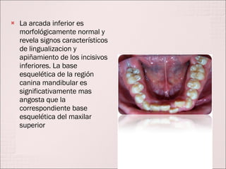 La arcada inferior es morfológicamente normal y revela signos característicos de lingualizacion y apiñamiento de los incisivos inferiores. La base esquelética de la región canina mandibular es significativamente mas angosta que la correspondiente base esquelética del maxilar superior 