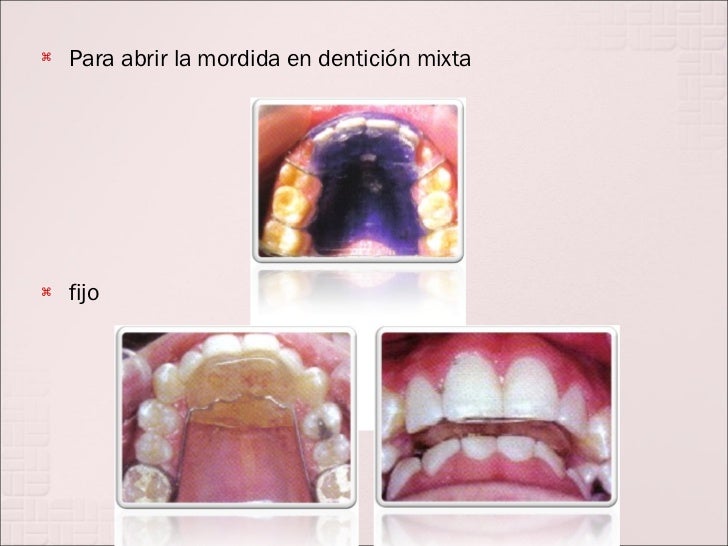 Tratamiento De Mordida Profunda En Dentición Temporal