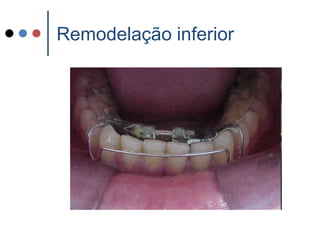Remodelação inferior