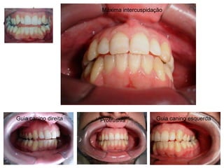 Máxima intercuspidaçãoGuia canino direita Guia canino esquerdaProtrusiva 