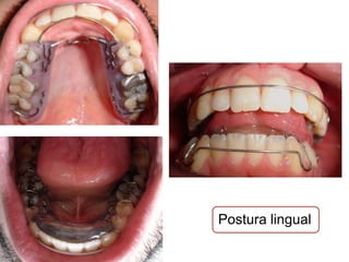Mordida Aberta   Mordida Cruzada