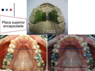 7 mesesRemodelação transversal