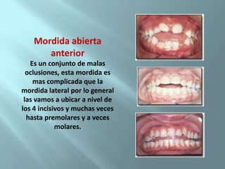 Mordida Abierta