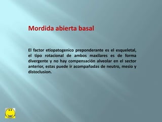 Mordida Abierta