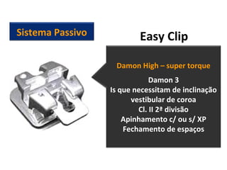 Easy ClipSistema Passivo
Damon High – super torque
Damon 3
Is que necessitam de inclinação
vestibular de coroa
Cl. II 2ª divisão
Apinhamento c/ ou s/ XP
Fechamento de espaços
 