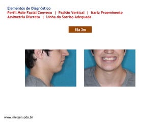 www.nielsen.odo.br
Elementos de Diagnóstico
Perfil Mole Facial Convexo | Padrão Vertical | Nariz Proeminente
Assimetria Discreta | Linha do Sorriso Adequada
18a 3m
 