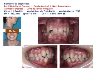 Elementos de Diagnóstico
Perfil Mole Facial Convexo | Padrão Vertical | Nariz Proeminente
Assimetria Discreta | Linha do Sorriso Adequada
Classe I | Overbite | Mordida Cruzada Post-direita | Mordida Aberta 12/43
DM = - 10,2 mm Spee = -3 mm DC = - 1,6 mm IMPA 88°
18a 3m
 