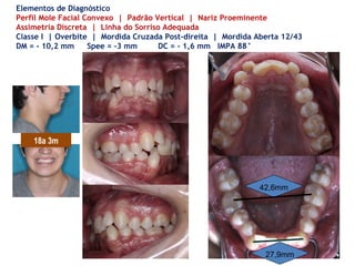 42,6mm
27,9mm
Elementos de Diagnóstico
Perfil Mole Facial Convexo | Padrão Vertical | Nariz Proeminente
Assimetria Discreta | Linha do Sorriso Adequada
Classe I | Overbite | Mordida Cruzada Post-direita | Mordida Aberta 12/43
DM = - 10,2 mm Spee = -3 mm DC = - 1,6 mm IMPA 88°
18a 3m
 