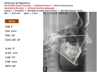 ANB 4°
Wits 2mm
FMA 29°
GoGn.SN 36°
Is-NA 9°
Is.NA 1mm
Ii-NB 23°
Ii.NB 4mm
IMPA 88°
Elementos de Diagnóstico
Perfil Mole Facial Convexo | Padrão Vertical | Nariz Proeminente
Assimetria Discreta | Linha do Sorriso Adequada
Classe I | Overbite | Mordida Cruzada Post-direita | Mordida Aberta 12/43
DM = - 10,2 mm Spee = -3 mm DC = - 1,6 mm IMPA 88°
18a 3m
 