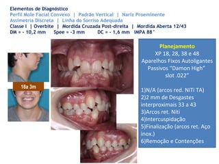Elementos de Diagnóstico
Perfil Mole Facial Convexo | Padrão Vertical | Nariz Proeminente
Assimetria Discreta | Linha do Sorriso Adequada
Classe I | Overbite | Mordida Cruzada Post-direita | Mordida Aberta 12/43
DM = - 10,2 mm Spee = -3 mm DC = - 1,6 mm IMPA 88°
18a 3m
Planejamento
XP 18, 28, 38 e 48
Aparelhos Fixos Autoligantes
Passivos “Damon High”
slot .022”
1)N/A (arcos red. NiTi TA)
2)2 mm de Desgastes
interproximais 33 a 43
3)Arcos ret. Niti
4)Intercuspidação
5)Finalização (arcos ret. Aço
inox.)
6)Remoção e Contenções
 