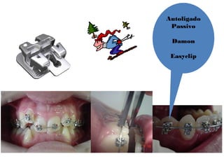 Autoligado
Passivo
Damon
Easyclip
 