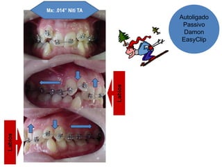 Autoligado
Passivo
Damon
EasyClip
 