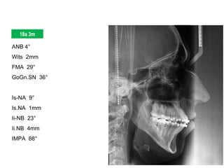 ANB 4°
Wits 2mm
FMA 29°
GoGn.SN 36°
Is-NA 9°
Is.NA 1mm
Ii-NB 23°
Ii.NB 4mm
IMPA 88°
18a 3m
 
