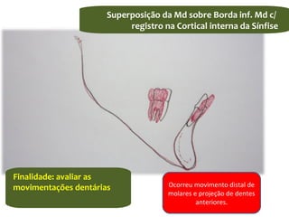 Superposição da Md sobre Borda inf. Md c/
registro na Cortical interna da Sínfise
Finalidade: avaliar as
movimentações dentárias Ocorreu movimento distal de
molares e projeção de dentes
anteriores.
 