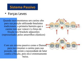 • Forças Leves
Sistema Passivo
 
