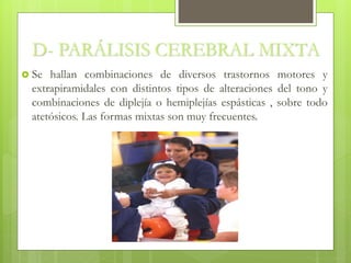D- PARÁLISIS CEREBRAL MIXTA
 Se hallan combinaciones de diversos trastornos motores y
extrapiramidales con distintos tipos de alteraciones del tono y
combinaciones de diplejía o hemiplejías espásticas , sobre todo
atetósicos. Las formas mixtas son muy frecuentes.
 