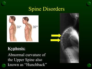 Spine Disorders Kyphosis: Abnormal curvature of the Upper Spine also known as “Hunchback”   