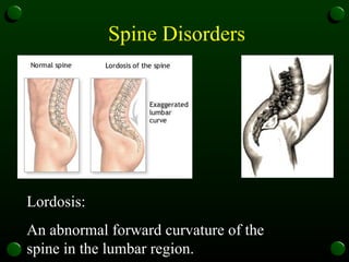 Spine Disorders Lordosis: An abnormal forward curvature of the spine in the lumbar region.  