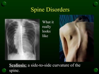 Spine Disorders Scoliosis:  a side-to-side curvature of the spine.  What it really looks like  