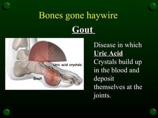 Bones gone haywire   Gout  Disease in which  Uric Acid  Crystals build up in the blood and deposit themselves at the joints.  